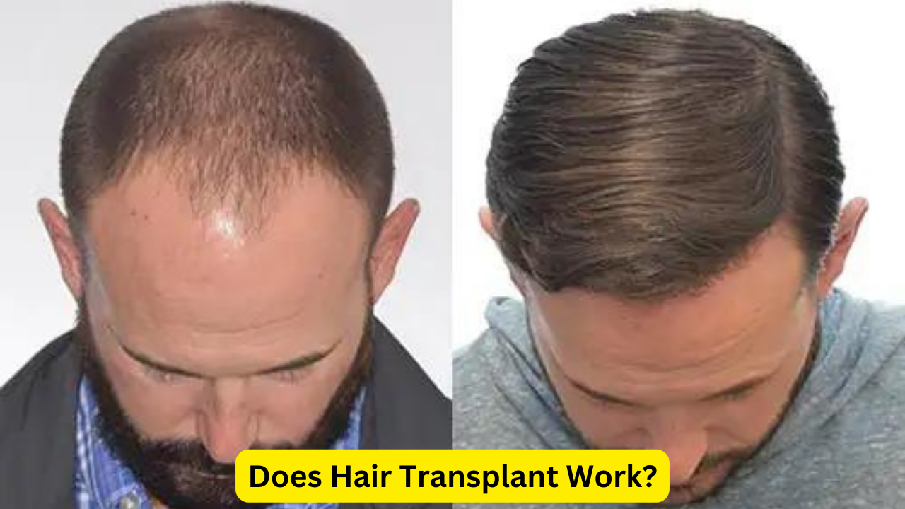 Does Hair Transplant Work?